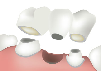 How Does A Dental Bridge Compare To Implants And Dentures?
