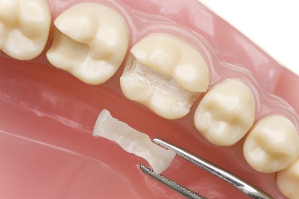 Resin bonding increases tooth length for short teeth