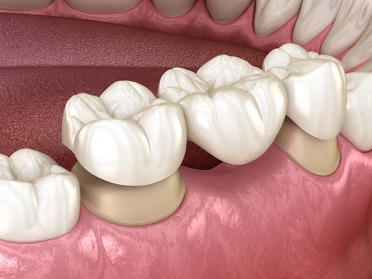 Repairing  Gaps With A Dental Bridge