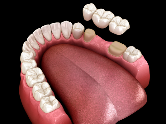 The Longevity Of Dental Bridges: What You Should Know