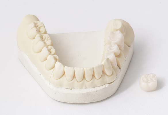 Dental Crown Materials FAQs