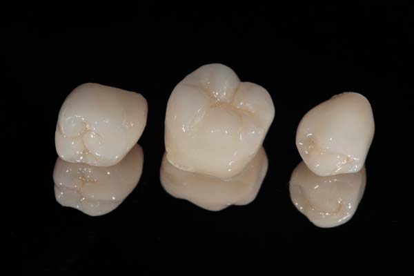 How A Tooth Is Prepared To Have A Dental Crown Restoration