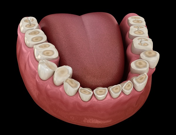 Should You Fix Your Teeth With A Dental Crown Or A Dental Bridge?