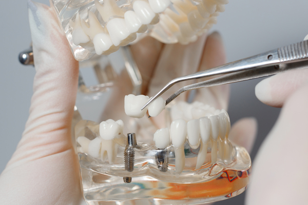 Tooth Replacement    : The Long Term Health Benefits Of Dental Implants