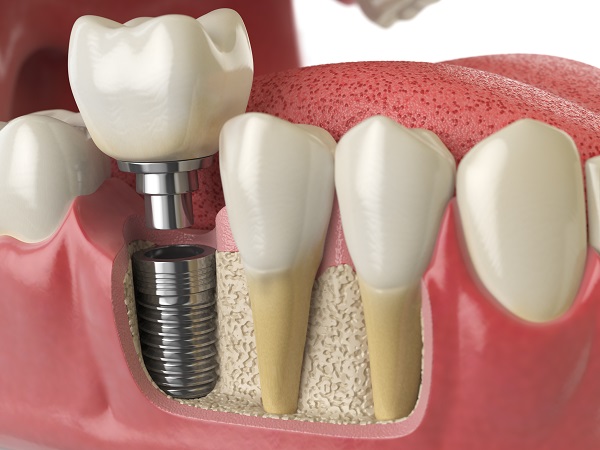 Can Dental Implants Be Removed?