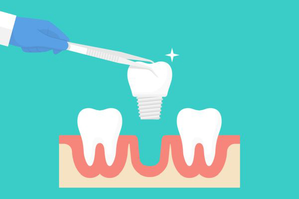Why You Should Choose Dental Implants To Replace Missing Teeth