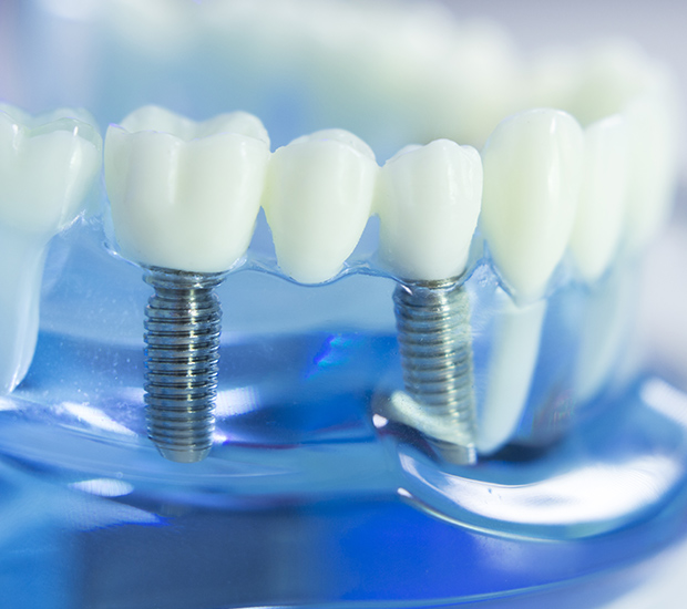 Bowie Dental Implants