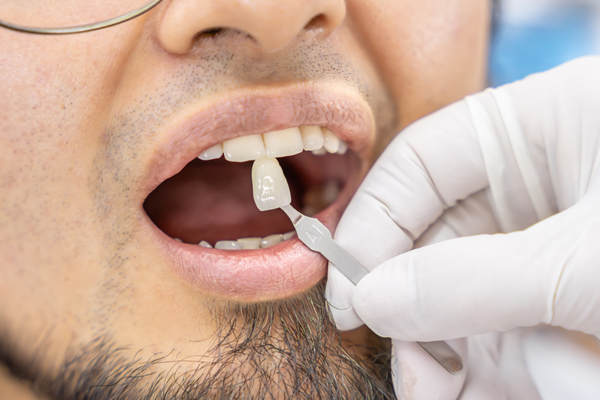 Tips To Keep Your Dental Veneers Looking Brand New