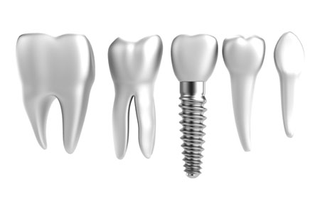 Mini Dental Implants Are A Good Alternative